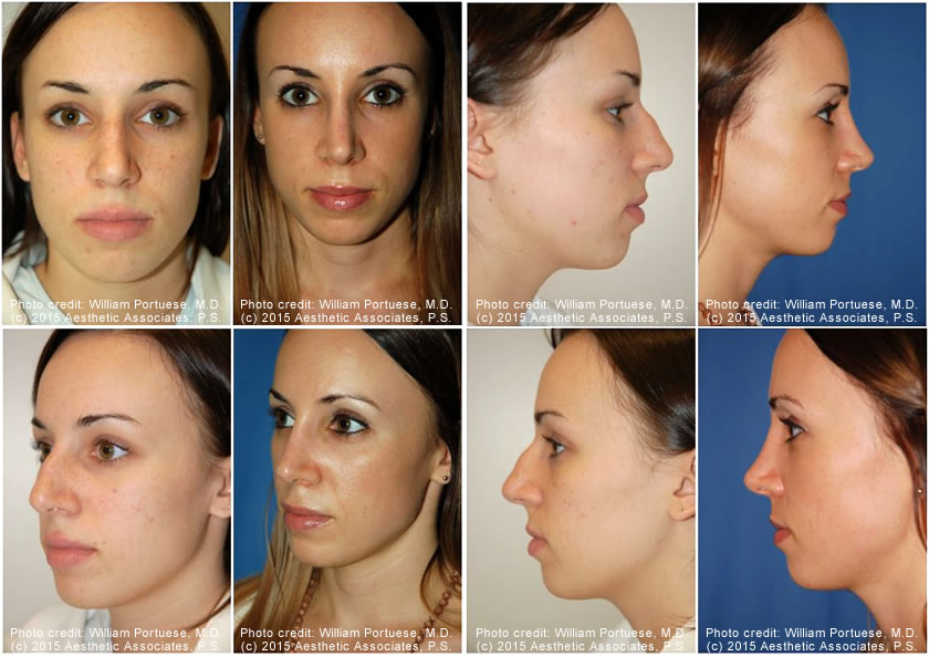Rhinoplasty Result 1